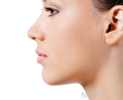 Rhinoplasty