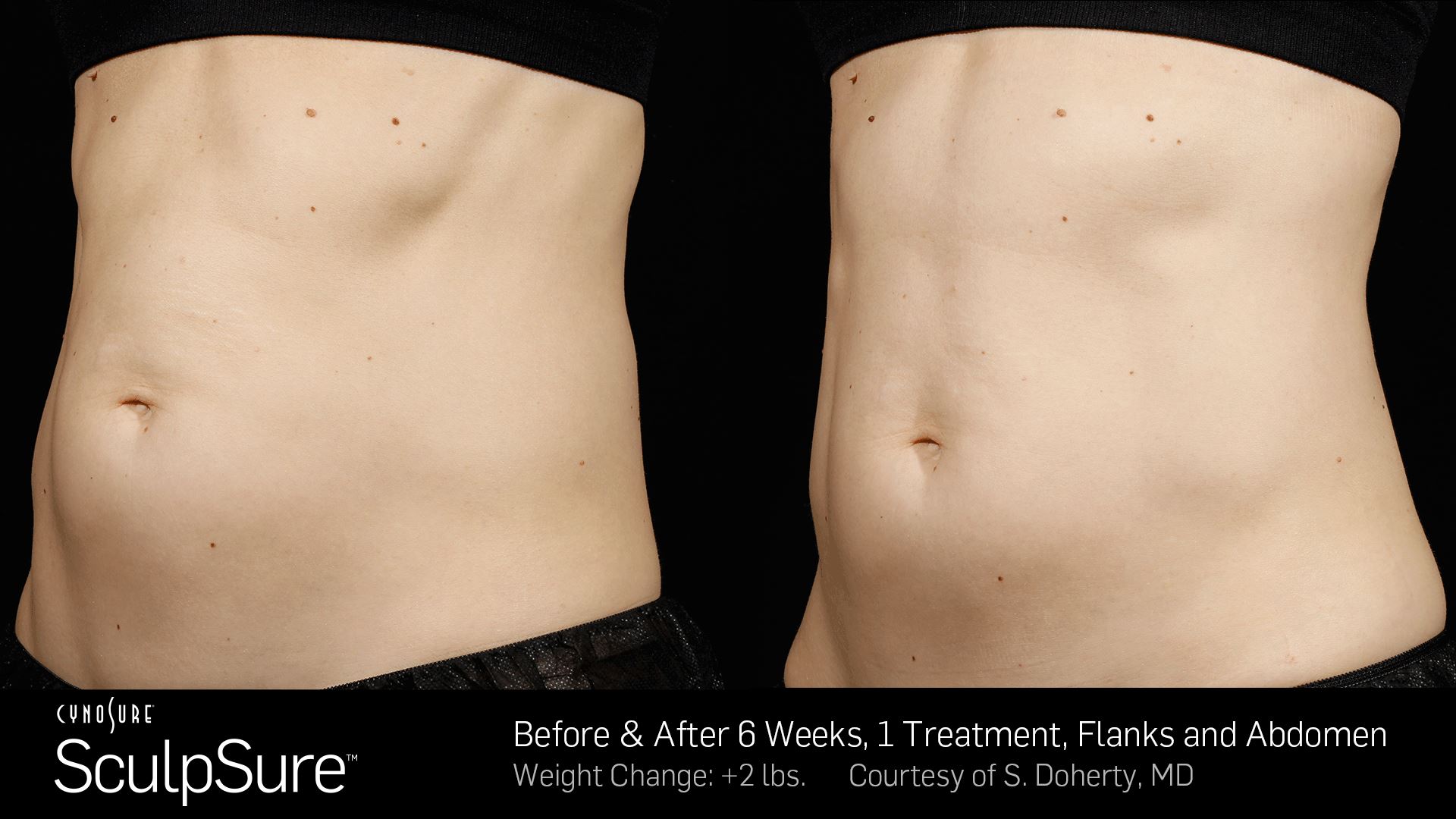 Flanks Fat Reduction In Miami